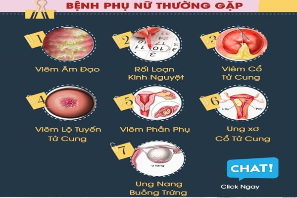 Các bệnh lý viêm phụ khoa thường gặp