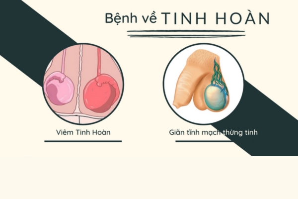 benh-o-tinh-hoan-nam